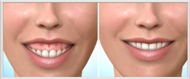 Sonrisa gingival cirugía ortognática Instituto Dental Doctor Carreño MADRID