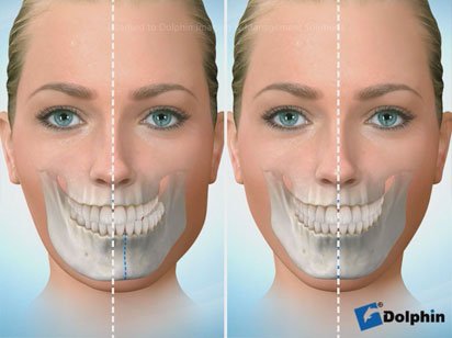 Instituto Dental Dr. Carreño, experto en cirugía ortognática. Correción asimetría facial.
