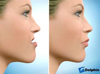 Instituto Dental Dr. Carreño, experto en cirugía ortognática. Correción mordida abierta.
