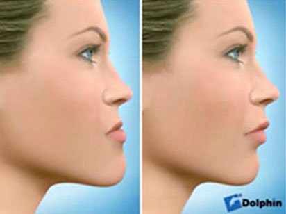 Instituto Dental Dr. Carreño, experto en cirugía ortognática. Correción prognatismo mandibular.
