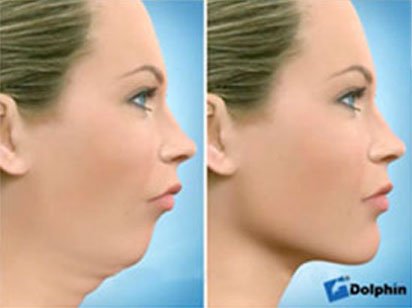 Instituto Dental Dr. Carreño, experto en cirugía ortognática. Correción retrognatia mandibular.