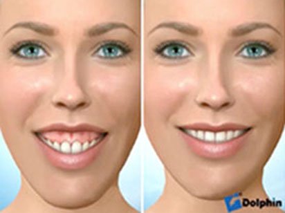 Instituto Dental Dr. Carreño, experto en cirugía ortognática. Correción sonrisa gingival.