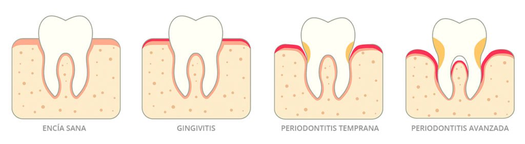 Evolución de la enfermedad periodontal. De gingivitis a periodontitis. Encías. Instituto Dental Doctor Carreño. Dentista Madrid