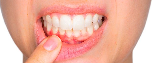 instituto-dental-dr-carreño-gingivitis-periodontitis-periodoncia-1