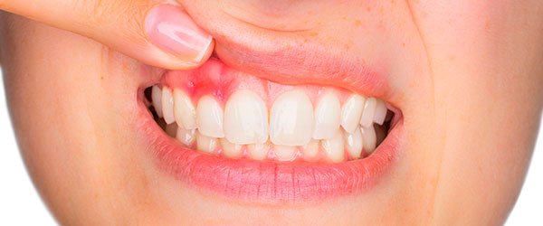 instituto-dental-dr-carreño-gingivitis-periodontitis-periodoncia-1